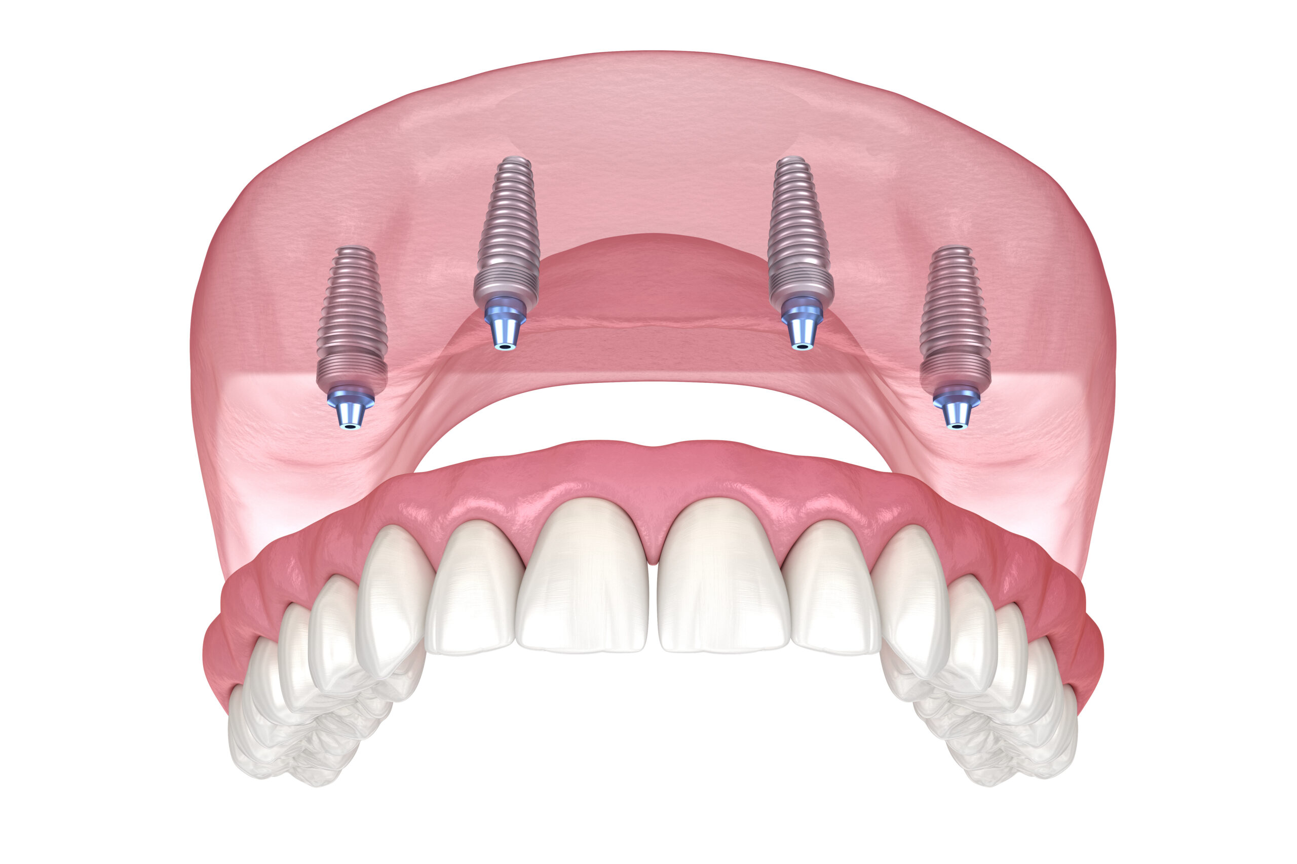Oberkieferprothese mit Zahnfleisch All on 4 System, getragen von Implantaten. Medizinisch exakte 3D-Darstellung von menschlichen Zähnen und Prothesen