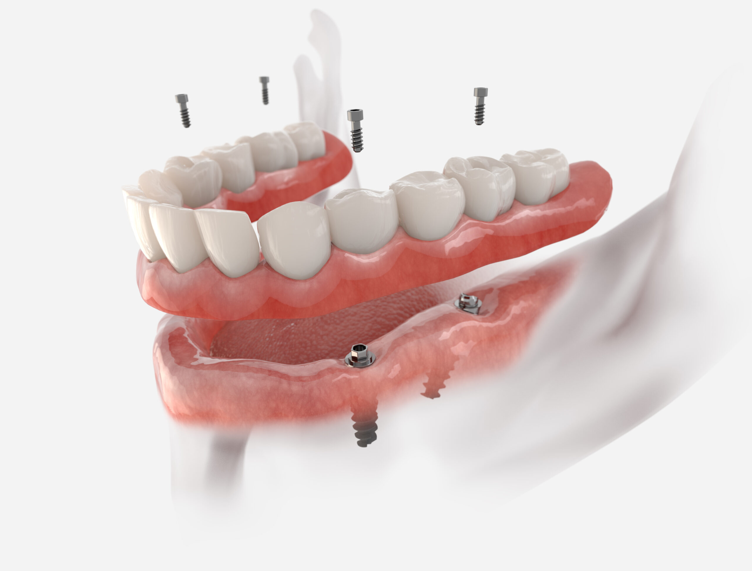 Festsitzende Versorgung des Unterkiefers mit 4 Implantaten, die posterior gekippt sind. 3d-Illustration eines Implantats auf weißem Hintergrund. Zahnprothetische Innovation.