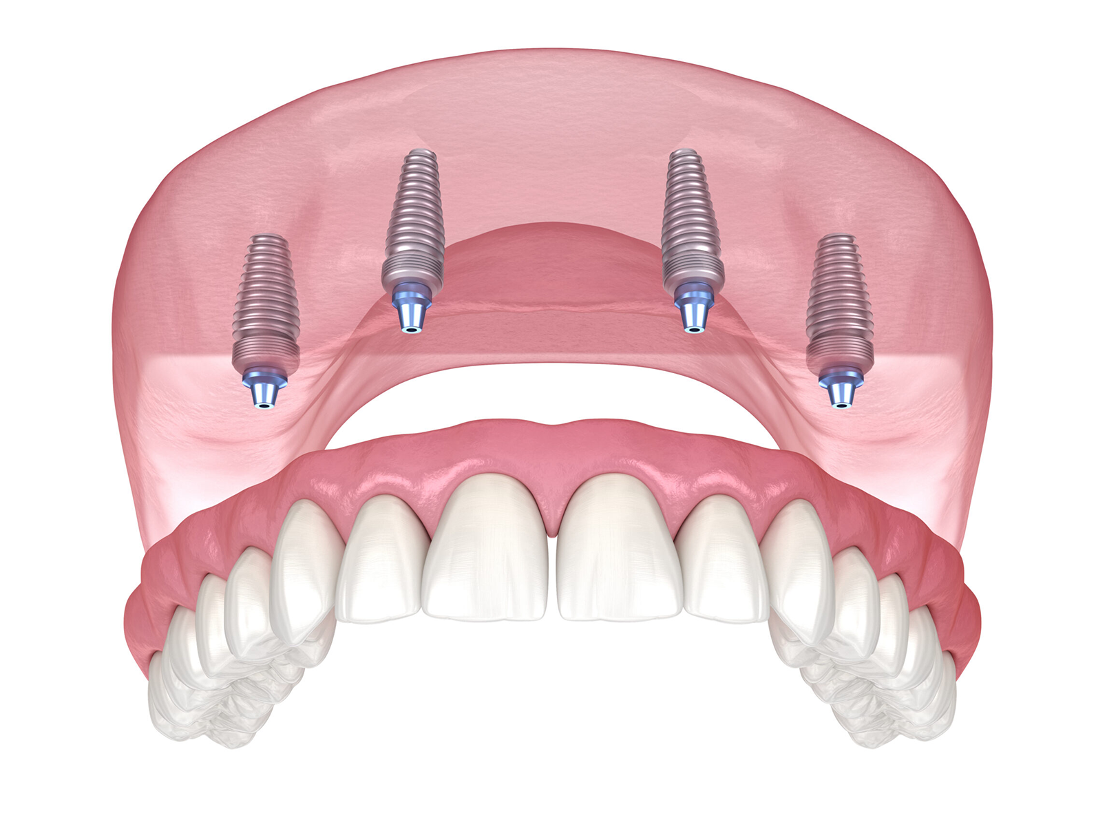 Brücke auf vier Implantaten (All-on-4)