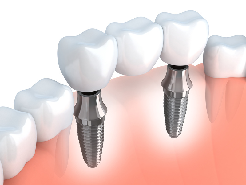 Brücke auf zwei Implantaten