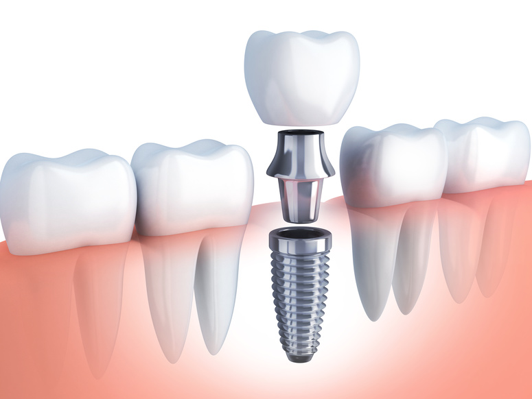 Krone auf Implantat